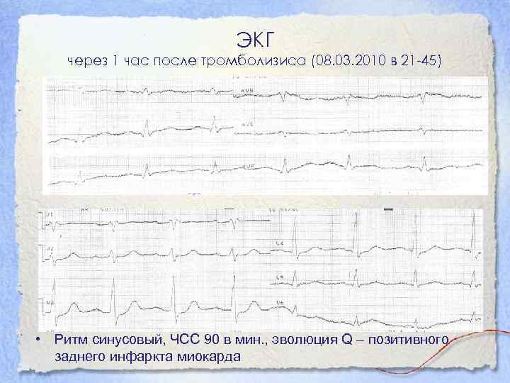 ЭКГ через 1 час после тромболизиса (08. 03. 2010 в 21 -45) • Ритм