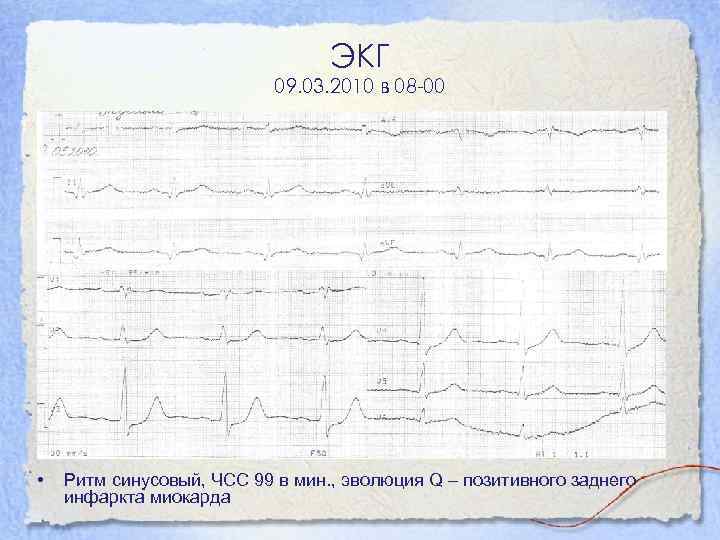 ЭКГ 09. 03. 2010 в 08 -00 • Ритм синусовый, ЧСС 99 в мин.