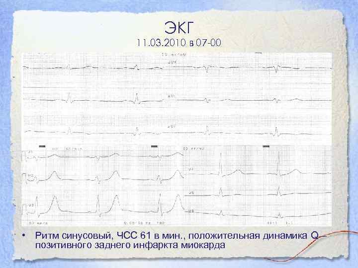 ЭКГ 11. 03. 2010 в 07 -00 • Ритм синусовый, ЧСС 61 в мин.