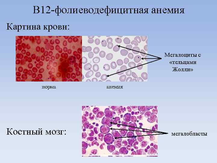 В 12 -фолиеводефицитная анемия Картина крови: Мегалоциты с «тельцами Жолли» норма Костный мозг: анемия