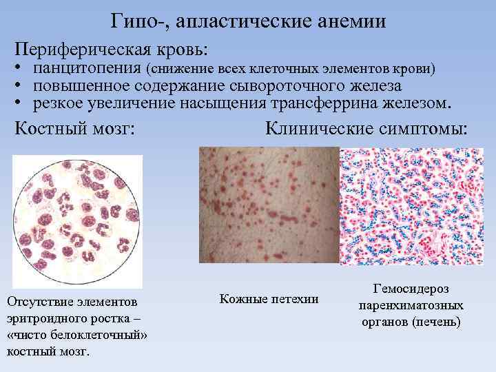 Гипо-, апластические анемии Периферическая кровь: • панцитопения (снижение всех клеточных элементов крови) • повышенное