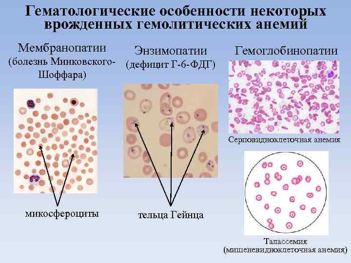 Гематологические особенности некоторых врожденных гемолитических анемий Мембранопатии Энзимопатии (болезнь Минковского- (дефицит Г-6 -ФДГ) Шоффара)