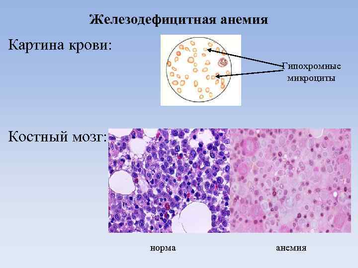 Железодефицитная анемия Картина крови: Гипохромные микроциты Костный мозг: норма анемия 