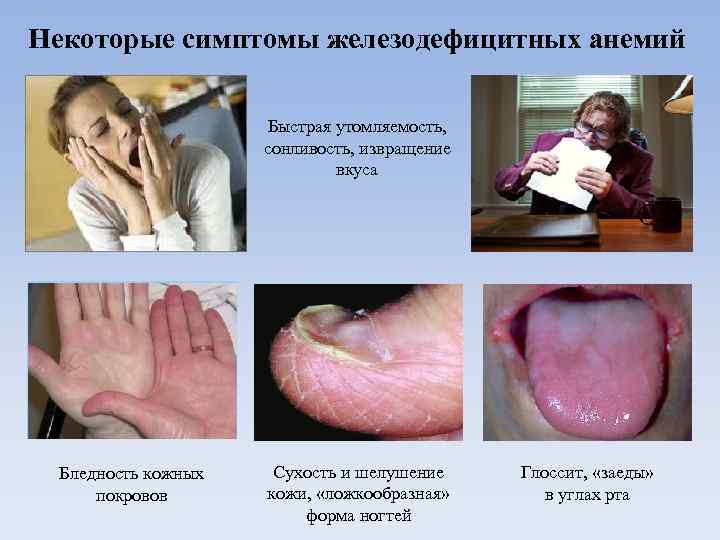 Некоторые симптомы железодефицитных анемий Быстрая утомляемость, сонливость, извращение вкуса Бледность кожных покровов Сухость и