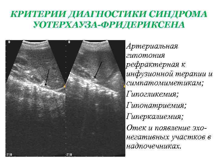 КРИТЕРИИ ДИАГНОСТИКИ СИНДРОМА УОТЕРХАУЗА-ФРИДЕРИКСЕНА • Артериальная гипотония рефрактерная к инфузионной терапии и симпатомиметикам; •