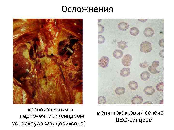 Осложнения кровоизлияния в надпочечники (синдром Уотерхауса-Фридериксена) менингококковый сепсис: ДВС-синдром 