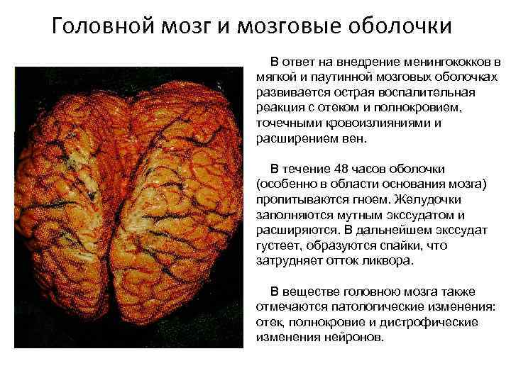 Головной мозг и мозговые оболочки В ответ на внедрение менингококков в мягкой и паутинной