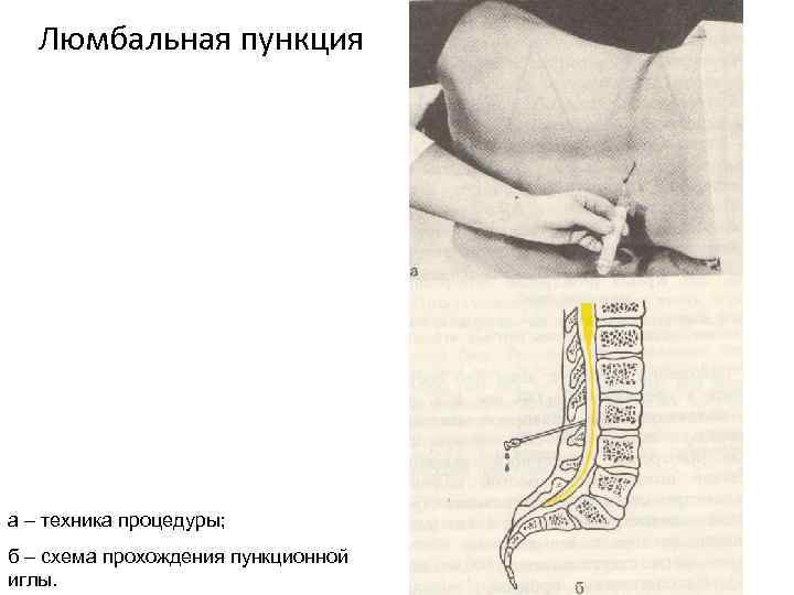 Люмбальная пункция а – техника процедуры; б – схема прохождения пункционной иглы. 