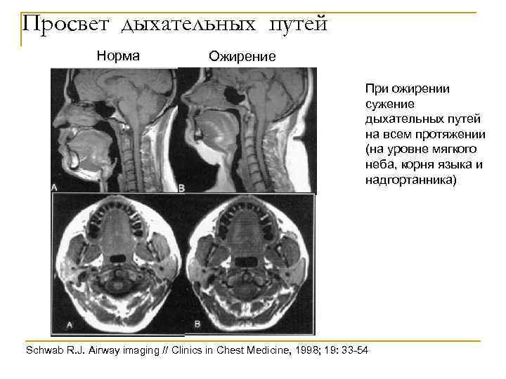 Просвет дыхательных путей Норма Ожирение При ожирении сужение дыхательных путей на всем протяжении (на
