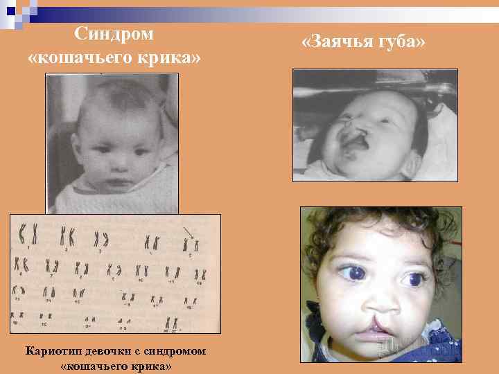Синдром «кошачьего крика» Кариотип девочки с синдромом «кошачьего крика» «Заячья губа» 