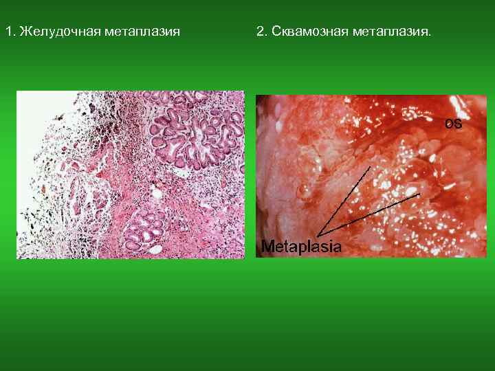  1. Желудочная метаплазия 2. Сквамозная метаплазия. 