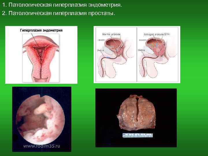 1. Патологическая гиперплазия эндометрия. 2. Патологическая гиперплазия простаты. 