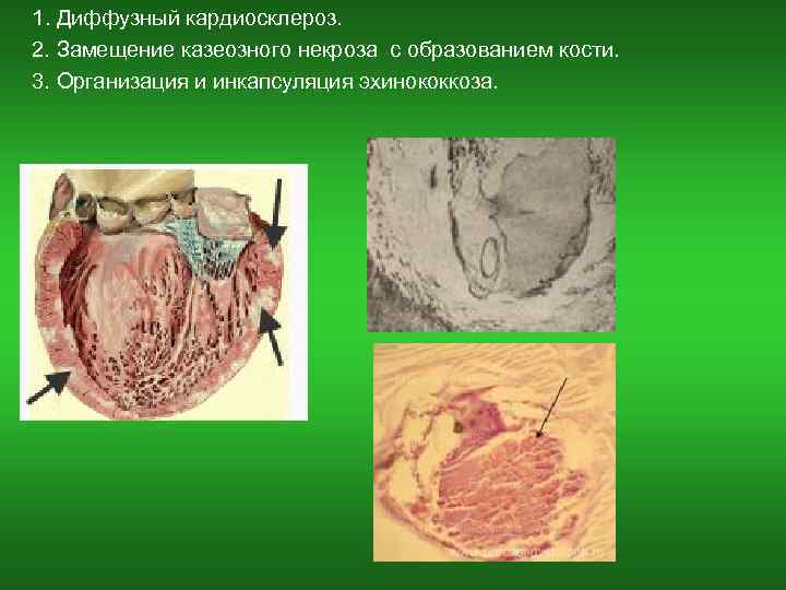  1. Диффузный кардиосклероз. 2. Замещение казеозного некроза с образованием кости. 3. Организация и