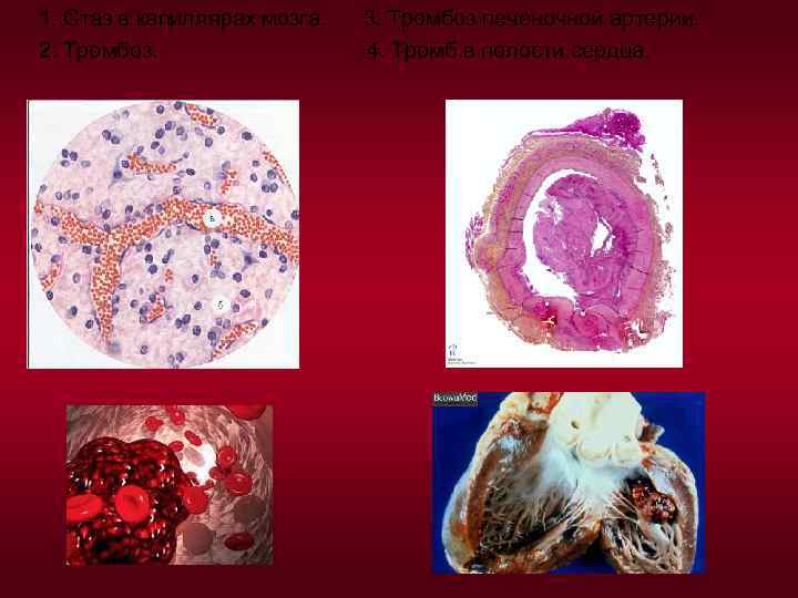 1. Стаз в капиллярах мозга. 2. Тромбоз. 3. Тромбоз печеночной артерии. 4. Тромб в
