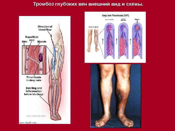 Тромбоз глубоких вен внешний вид и схемы. 