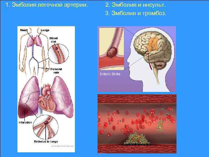 1. Эмболия легочной артерии. 2. Эмболия и инсульт. 3. Эмболия и тромбоз. 