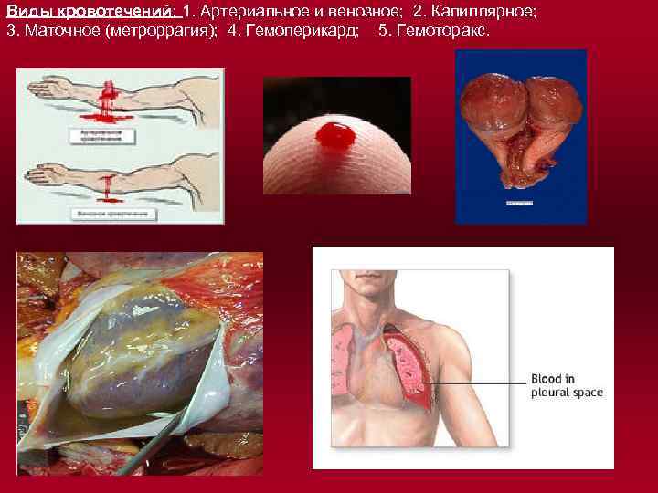 Виды кровотечений: 1. Артериальное и венозное; 2. Капиллярное; 3. Маточное (метроррагия); 4. Гемоперикард; 5.