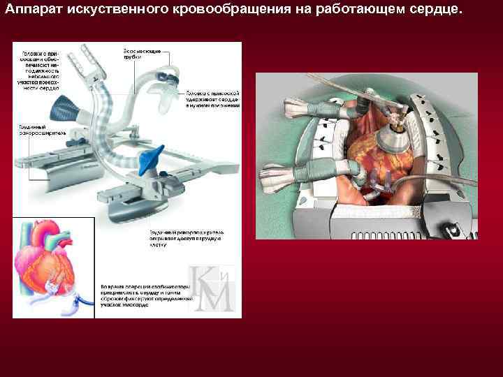 Аппарат искуственного кровообращения на работающем сердце. 