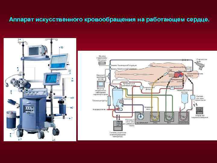 Аппарат искусственного кровообращения на работающем сердце. 