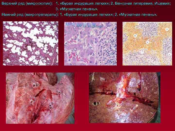Верхний ряд (микроскопия): 1. «Бурая индурация легких» ; 2. Венозная гиперемия. Ишемия; 3. «Мускатная