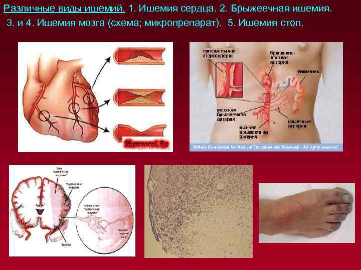 Различные виды ишемий. 1. Ишемия сердца. 2. Брыжеечная ишемия. 3. и 4. Ишемия мозга