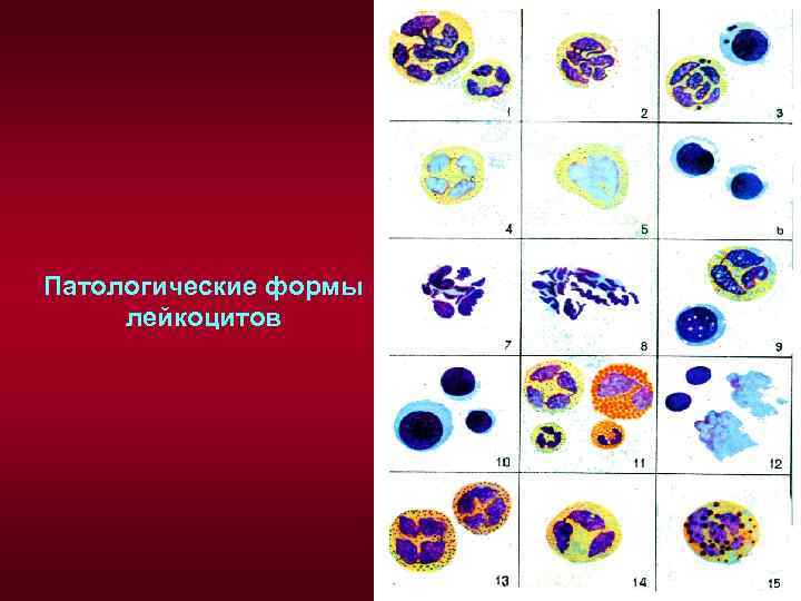 Форма лейкоцитов. Патологические дегенеративные формы лейкоцитов. Патологические формы лейкоцитов патофизиология. Дегенеративные и регенеративные формы лейкоцитов. Патологические формы лейкоцитов регенеративные.