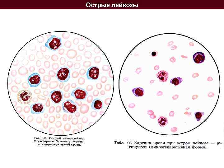 Острый лейкоз тест с ответами. Лейкемия картина крови. Картина крови при остром лимфолейкозе. Острый эритробластный лейкоз картина крови. Картина крови острого миелолейкоза.
