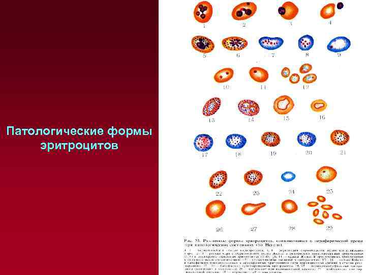 Патологические формы эритроцитов 