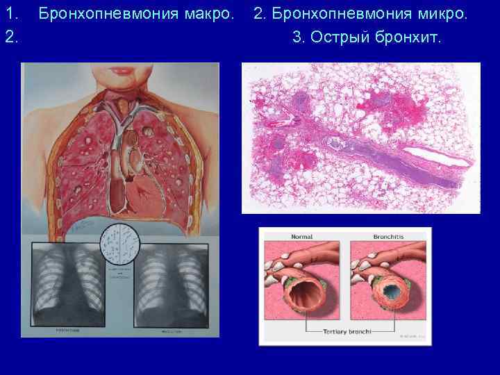 Бронхопневмония карта вызова