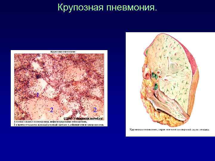 Крупозная пневмония. 