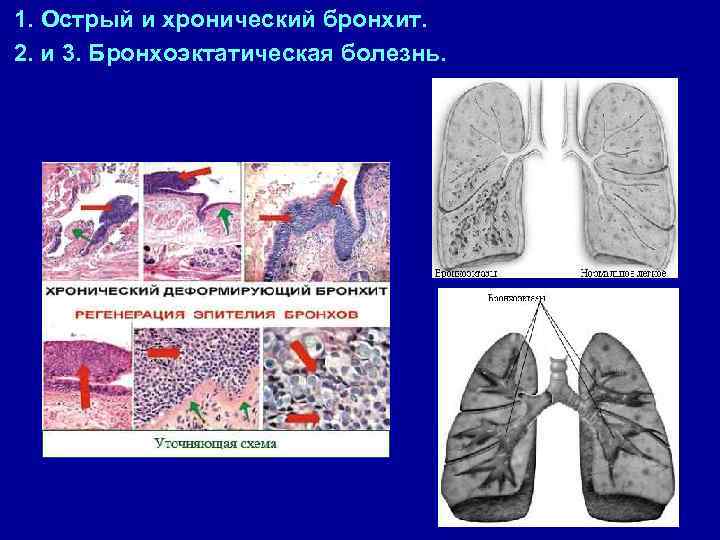 Усиление и обогащение сосудисто бронхиального рисунка