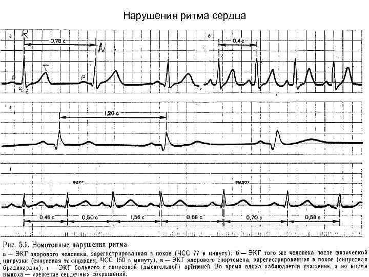 Нарушения ритма сердца 