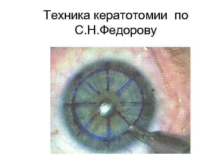 Техника кератотомии по С. Н. Федорову 