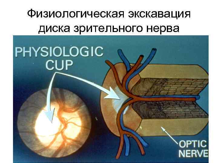 Физиологическая экскавация диска зрительного нерва 