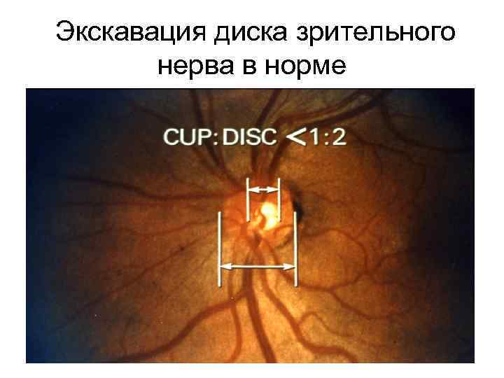 Экскавация диска зрительного нерва в норме 