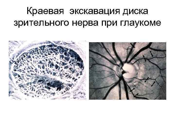 Краевая экскавация диска зрительного нерва при глаукоме 