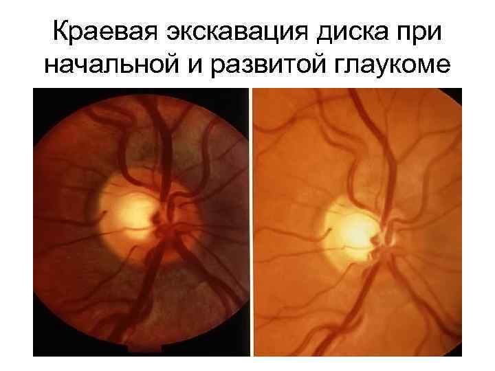 Краевая экскавация диска при начальной и развитой глаукоме 