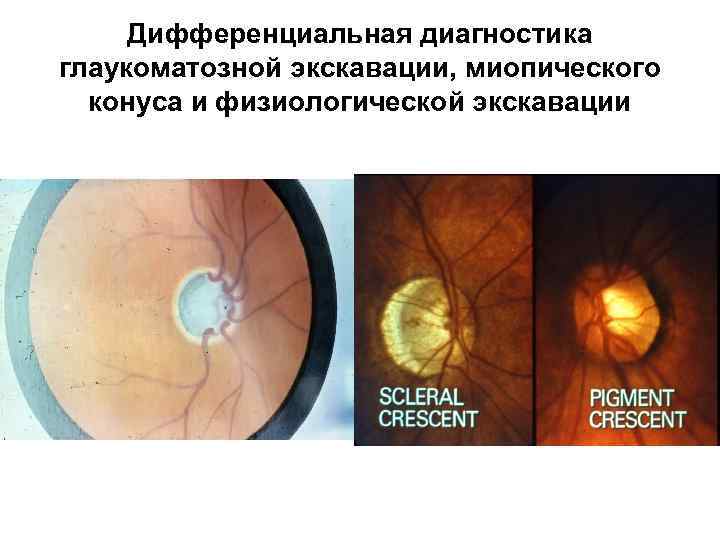Дифференциальная диагностика глаукоматозной экскавации, миопического конуса и физиологической экскавации 