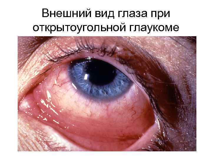 Внешний вид глаза при открытоугольной глаукоме 