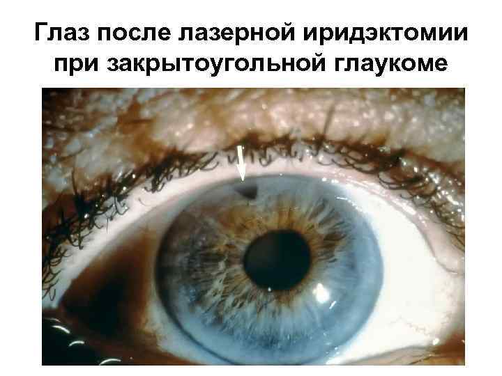 Глаз после лазерной иридэктомии при закрытоугольной глаукоме 