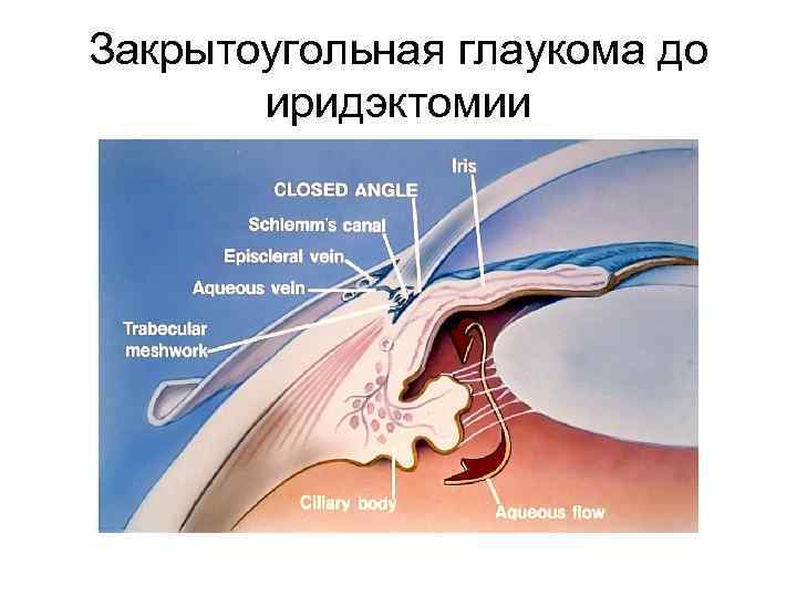 Закрытоугольная глаукома до иридэктомии 