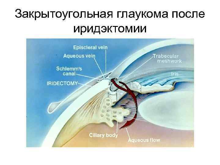 Закрытоугольная глаукома после иридэктомии 