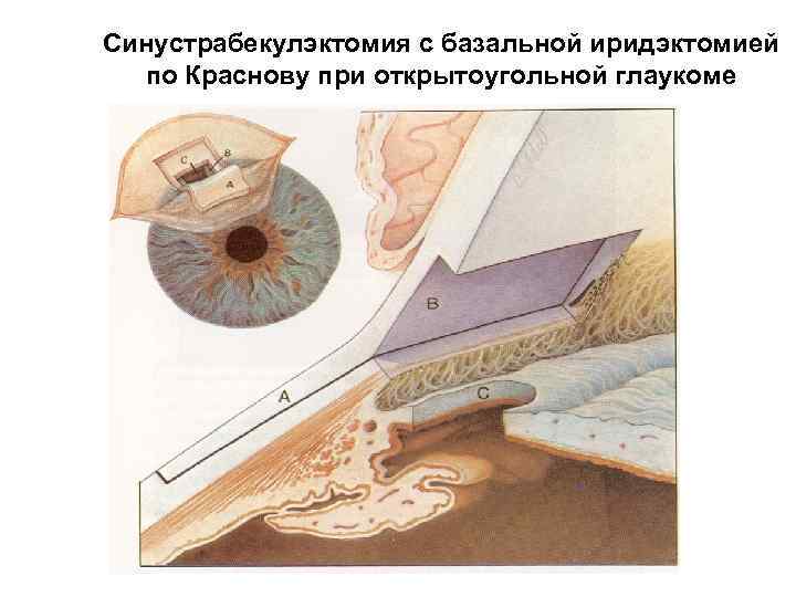 Синустрабекулэктомия с базальной иридэктомией по Краснову при открытоугольной глаукоме 