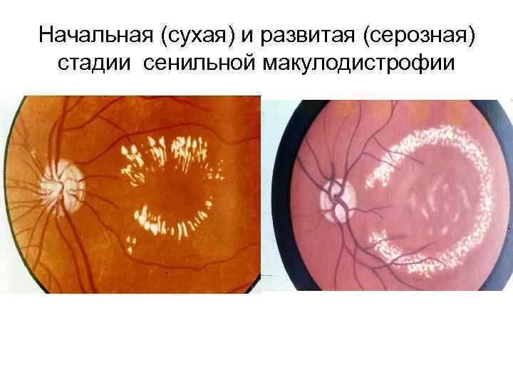 Начальная (сухая) и развитая (серозная) стадии сенильной макулодистрофии 