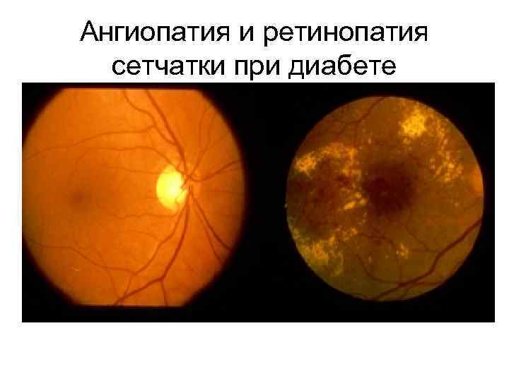 Ангиопатия и ретинопатия сетчатки при диабете 