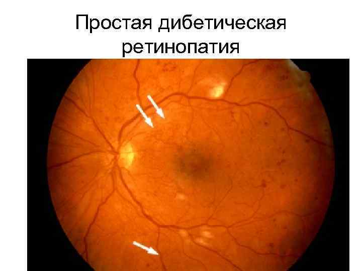 Простая дибетическая ретинопатия 