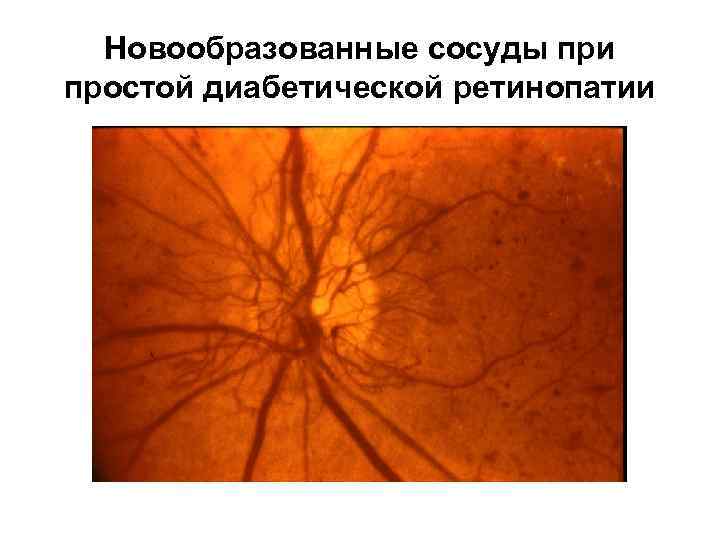 Новообразованные сосуды при простой диабетической ретинопатии 