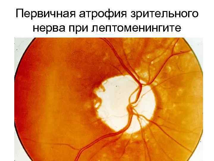 Первичная атрофия зрительного нерва при лептоменингите 