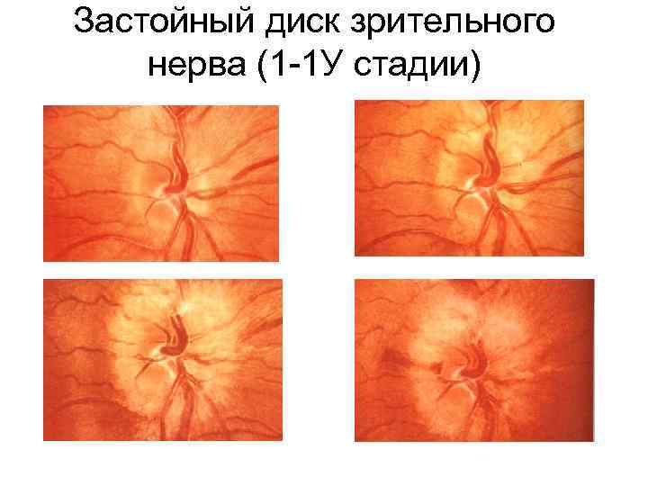 Застойный диск зрительного нерва (1 -1 У стадии) 