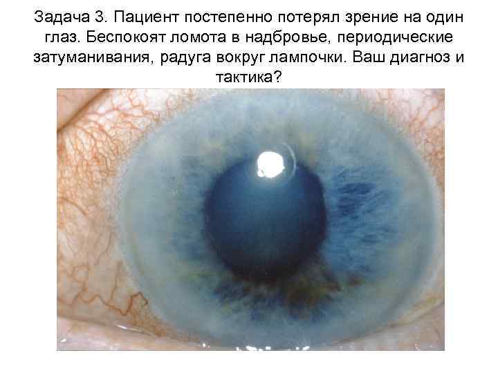 Задача 3. Пациент постепенно потерял зрение на один глаз. Беспокоят ломота в надбровье, периодические
